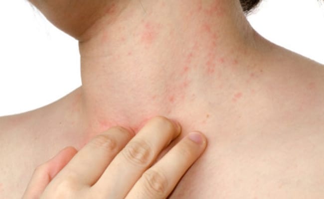 Onion Allergy And Remedies What Are The Symptoms Of An Onion Allergy