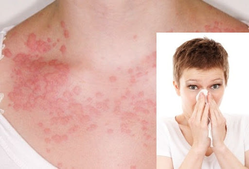 Onion Allergy And Remedies What Are The Symptoms Of An Onion Allergy